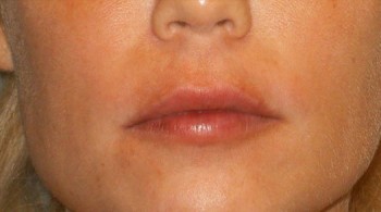 Маски для збільшення губ в домашніх умовах, омолодження шкіри