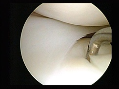 Meniscus (anatomie) - reeditare Wikipedia