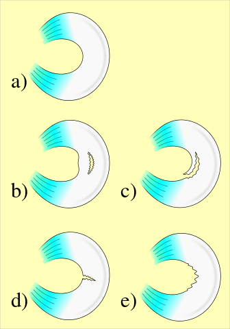 Meniscus (anatomie) - reeditare Wikipedia