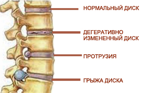 Міжхребцева грижа лікування в домашніх умовах, вправи, профілактика