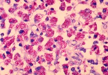 Мікобактеріози і туберкульоз - диференціальна діагностика