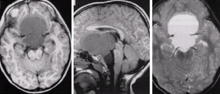 Експерт MRI, MRI диагностика на заболявания на хипофизата