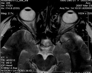 Експерт MRI, MRI диагностика на заболявания на хипофизата