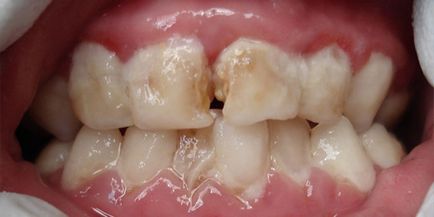 A plakk a fogak a gyermek okozza a fekete, sárga, barna és fehér