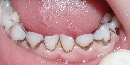 Наліт на зубах у дитини причини чорного, жовтого, коричневого та білого