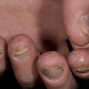 Народні засоби від грибка нігтів на руках лікування в домашніх умовах