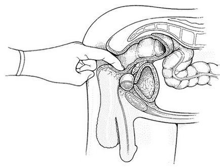 Prostatita non-bacteriană provoacă și posibile căi de tratament