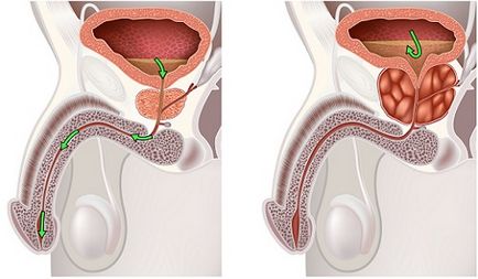 Небактеріальний простатит причини і можливі способи лікування