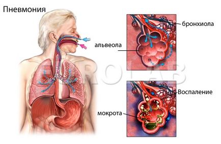 Pneumonia nozocomială, eurolab, pulmonologie