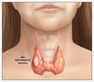 Este cancerul tiroidian, simptomele sale și prognosticul tratamentului periculoase?