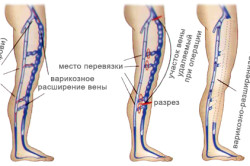 Chirurgie pentru îndepărtarea venelor varicoase