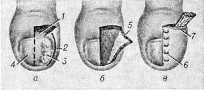 Operațiunea Schmiden cu unghii înguste