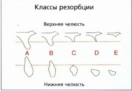 Optimizarea patului implantului cu osteotomi