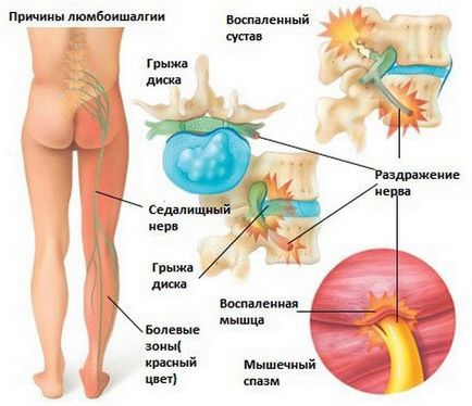 Остеохондроз шийного і поперекового відділів хребта і невралгія, неврологічні прояви,