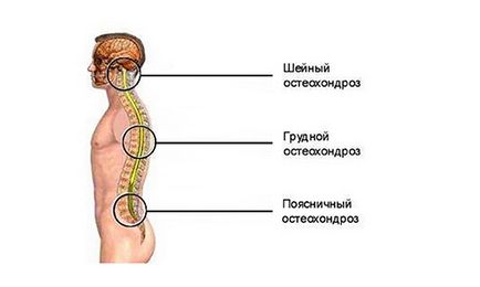 Остеохондроз шийного і поперекового відділів хребта і невралгія, неврологічні прояви,