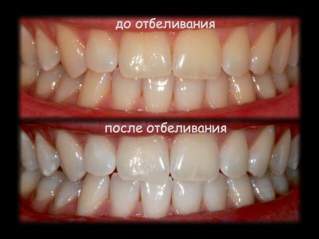 Відбілювання або чищення зубів що краще, стоматологія на київській в москві