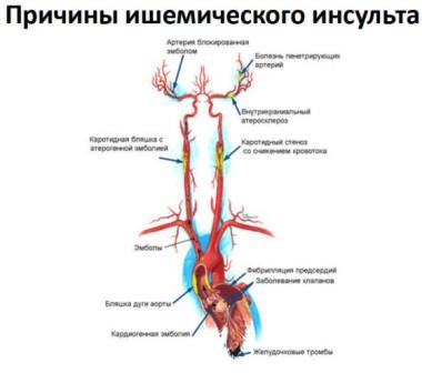 Diferențe în accident vascular cerebral ischemic, cauze, factori de risc