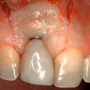 Відторгнення зубних імплантів ознаки і причини, як відбувається відторгнення імпланта