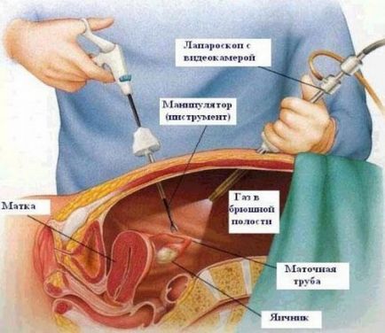 Ovulația după laparoscopie, efectul intervenției chirurgicale asupra concepției