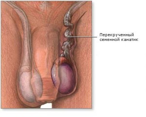 Torsiunea testiculară, etiologia bolii, simptomele, tratamentul