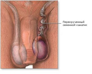 Перекрут яєчка етіологія захворювання, симптоми, лікування