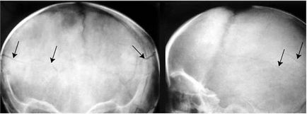 Fractura osului parietal la copil liniară, zdrobită