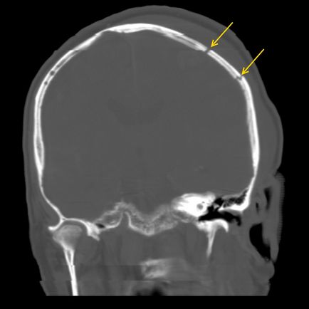 Fractura osului parietal la copil liniară, zdrobită