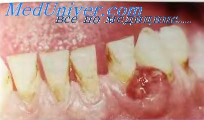 Granulom piogenic al gingiilor