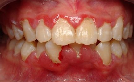 De ce gingiile umflate, durere, decât pentru a trata umflarea, remedii populare