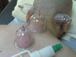 Чому може бути погано під час і після хіджами, hijama bio