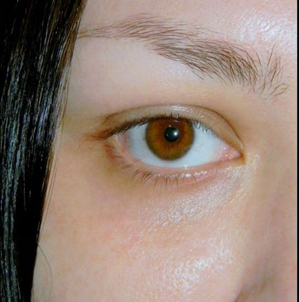 Чому з'являються зморшки причини зморшок під очима, у скільки років з'являються перші, омолодження