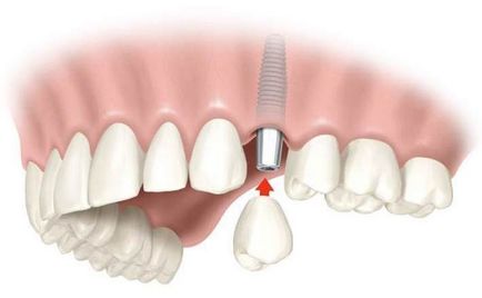Restaurare completă a dinților - implantare, adamant