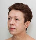 Az injekciós készítmény intradermális adagolásra yalupro HMW jalupro® HMW (peeling) Az injekciós készítmény intradermális injekció yalupro HMW jalupro® HMW