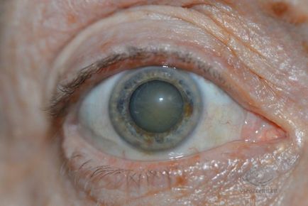 Причини лікування профілактика катаракти