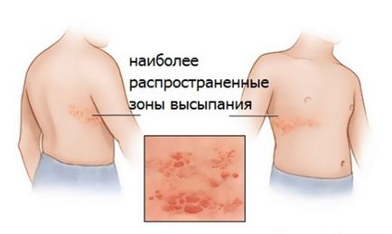Cauze de acnee pe abdomen
