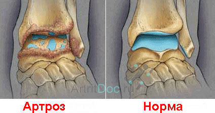 Причини, симптоми, ступеня і лікування артрозу гомілковостопного суглоба, деформуючий артроз