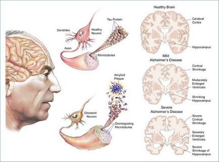 Okai Az Alzheimer-kór, az öröklődés és a dohányzás