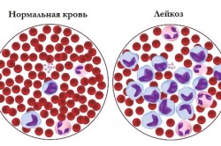 Причини виникнення лейкемії