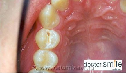 Utilizarea laserelor în stomatologie terapeutică - lasere dentare și laser