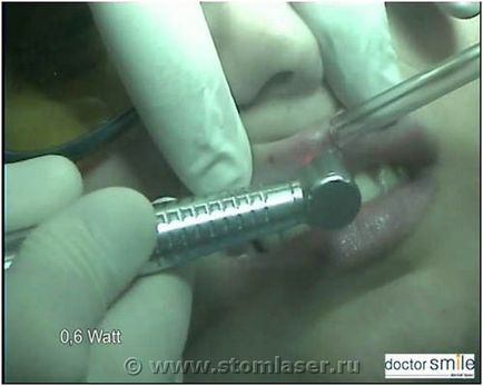 Utilizarea laserelor în stomatologie terapeutică - lasere dentare și laser