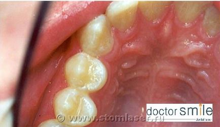 Utilizarea laserelor în stomatologie terapeutică - lasere dentare și laser