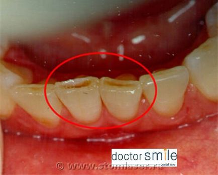 Utilizarea laserelor în stomatologie terapeutică - lasere dentare și laser