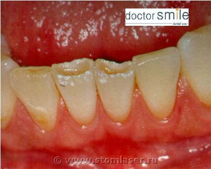 Utilizarea laserelor în stomatologie terapeutică - lasere dentare și laser