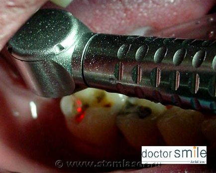 Застосування лазерів в терапевтичної стоматології - стоматологічні лазери і лазерне