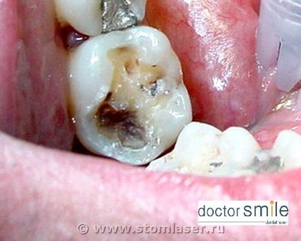 Utilizarea laserelor în stomatologie terapeutică - lasere dentare și laser