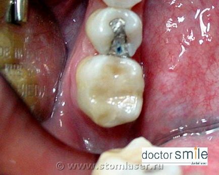 Utilizarea laserelor în stomatologie terapeutică - lasere dentare și laser