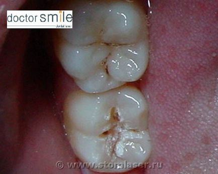 Utilizarea laserelor în stomatologie terapeutică - lasere dentare și laser