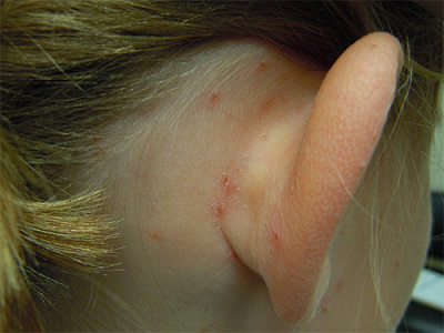 Acnee peste urechi moduri populare de tratament