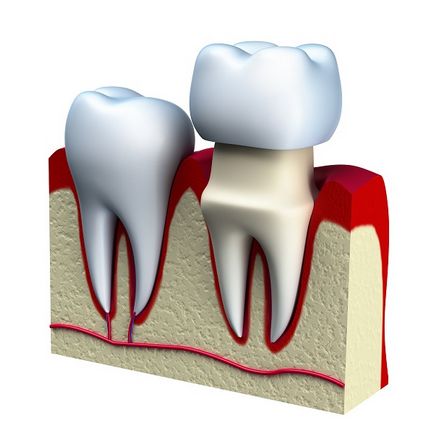 Протезування зубів, види