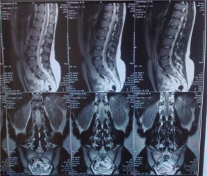 Atragerea de discuri, simptome și diagnostice, opțiuni de tratament